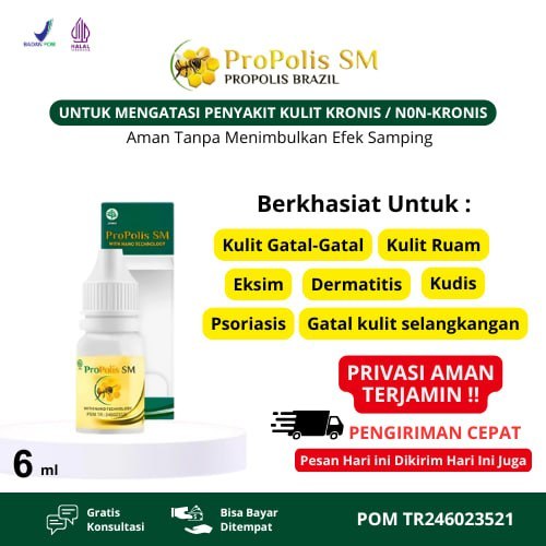 Obat Cacar / Obat Cacar Api - Herbal Penghilang Cacar Air Untuk Dewasa / Cacar Anak, Obat Cacar Air 