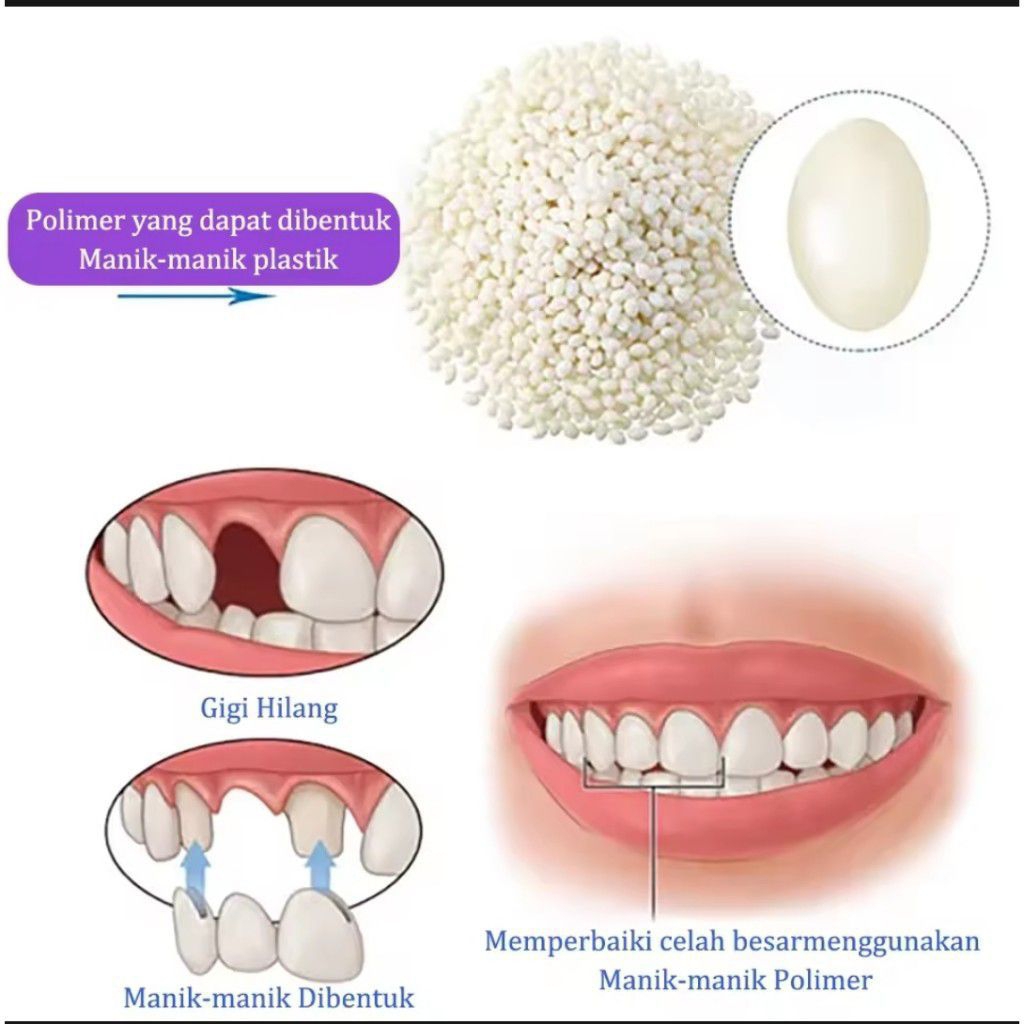 Isi 1000 Butir Penyelamat Gigi / Gel Gigi Padat / Menambal Gigi Palsu / Menambal Gigi Berlubang / Me