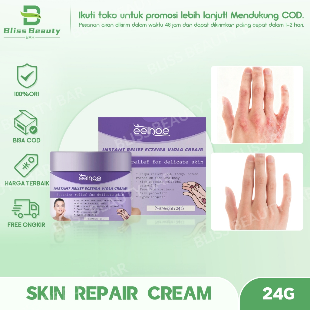 Psoriasis Repair Cream Anti Itch Antibacterial Inhibits Skin Fungus Eczematoid Hand Tinea Redness De