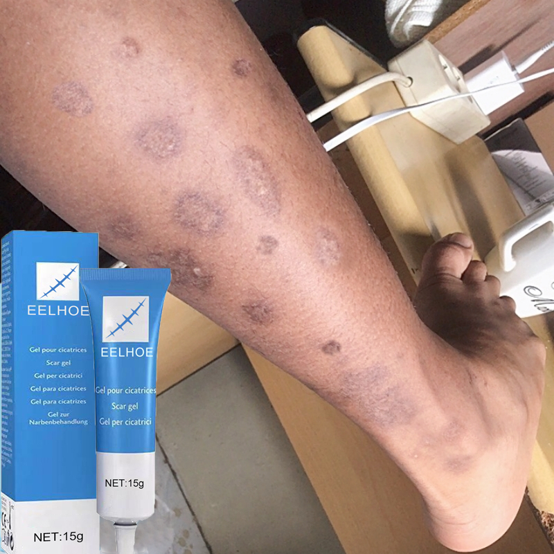 penghilang bekas luka koreng dan kudis Penghilang bekas gigitan nyamuk Penghilang bekas luka hitam k