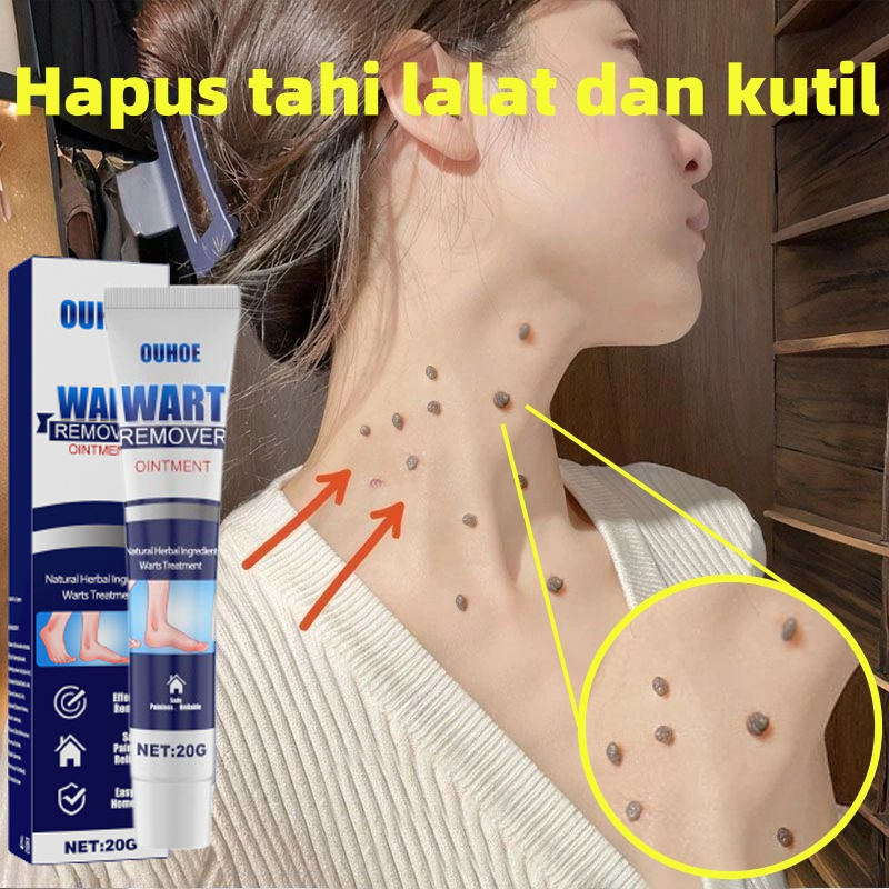 Penghilang Kutil Dan Tahi Lalat Obat Penghilang Kutil Di Wajah Papiloma Wajah Kutil Leher Penghilang