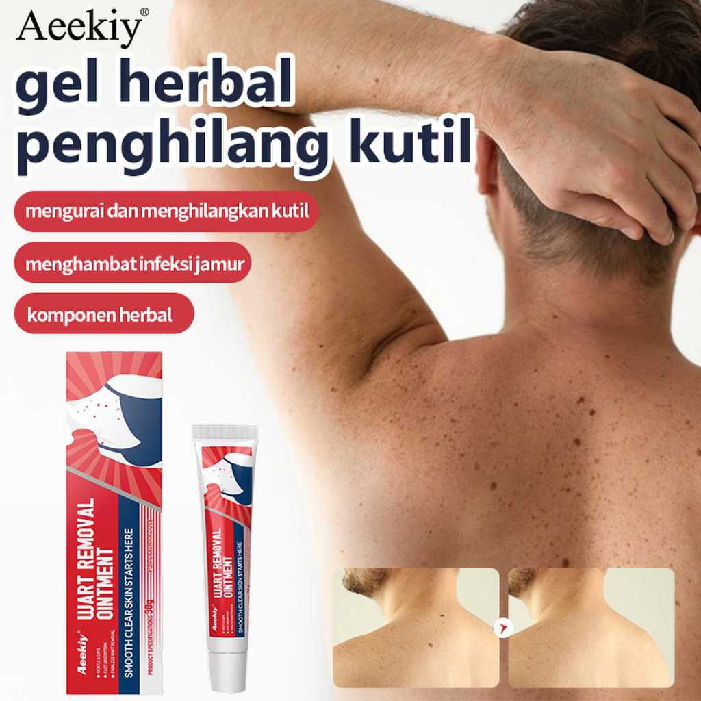 Aeekiy Salep Herbal Penghilang Kutil dan Tahi Lalat, Menghilangkan Kutil dan Tahi Lalat dengan Cepat