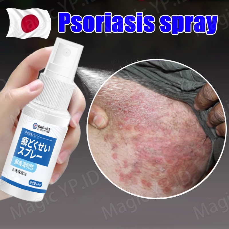 obat eksim obat gatal selangkangan psoriasis spray anti-gatal penghilang eksim kurap psoriasis