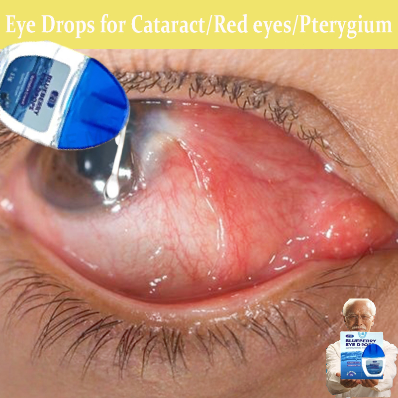 Obat mata katarak Blueberry Eye drop Obat mata merah Pengobatan mata rabun mata buram mata kering sa