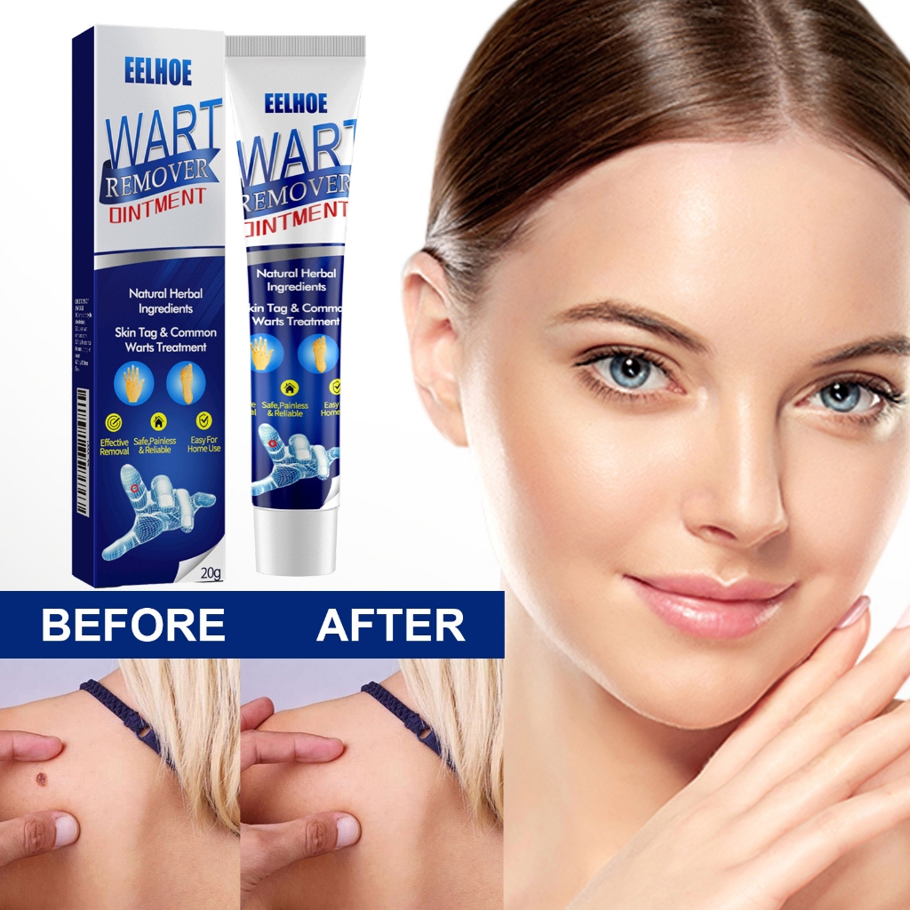 Eelhoe Herbal Cream Penghilang Kutil Tahi Lalat Ampuh 20g Wart Remover Cream