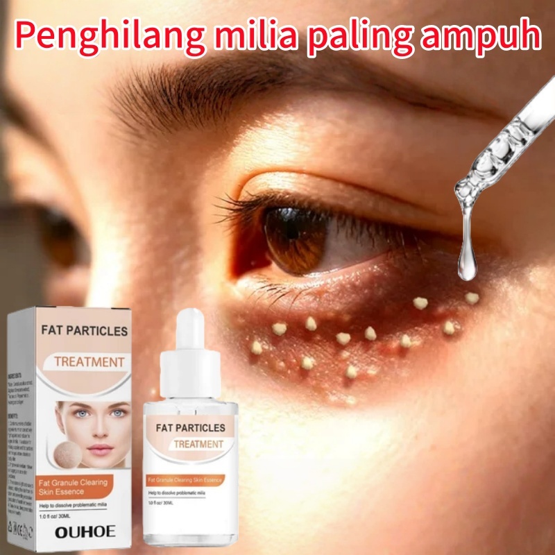 Obat milia Penghilang milia paling ampuh Milia di bawah mata Serum milia Butiran Lemak Sekitar Mata 