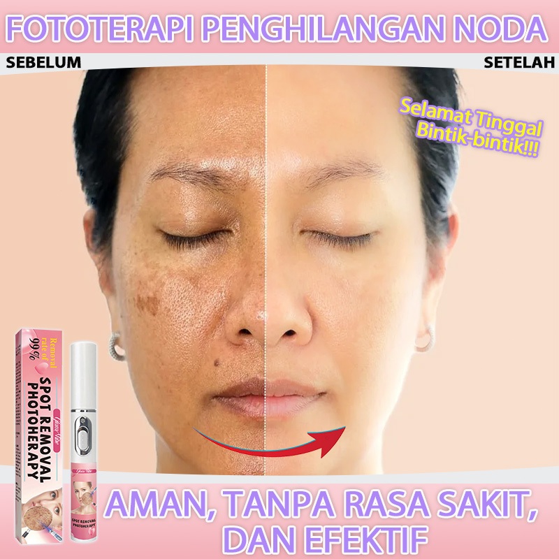 Pena laser menghilangkan flek hitam di wajah penghilang flek hitam membandel bintik