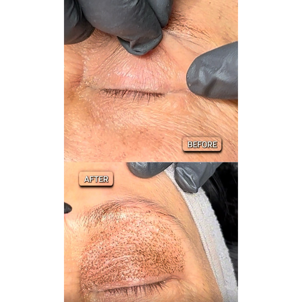 Plasma Fibroblast Full Eyes