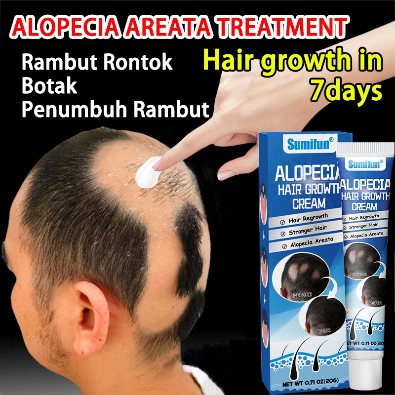 100% ORI Penumbuh rambut Obat Botak Koin Obat Oles Alopecia Areata 20g penumbuh rambut serum penumbu