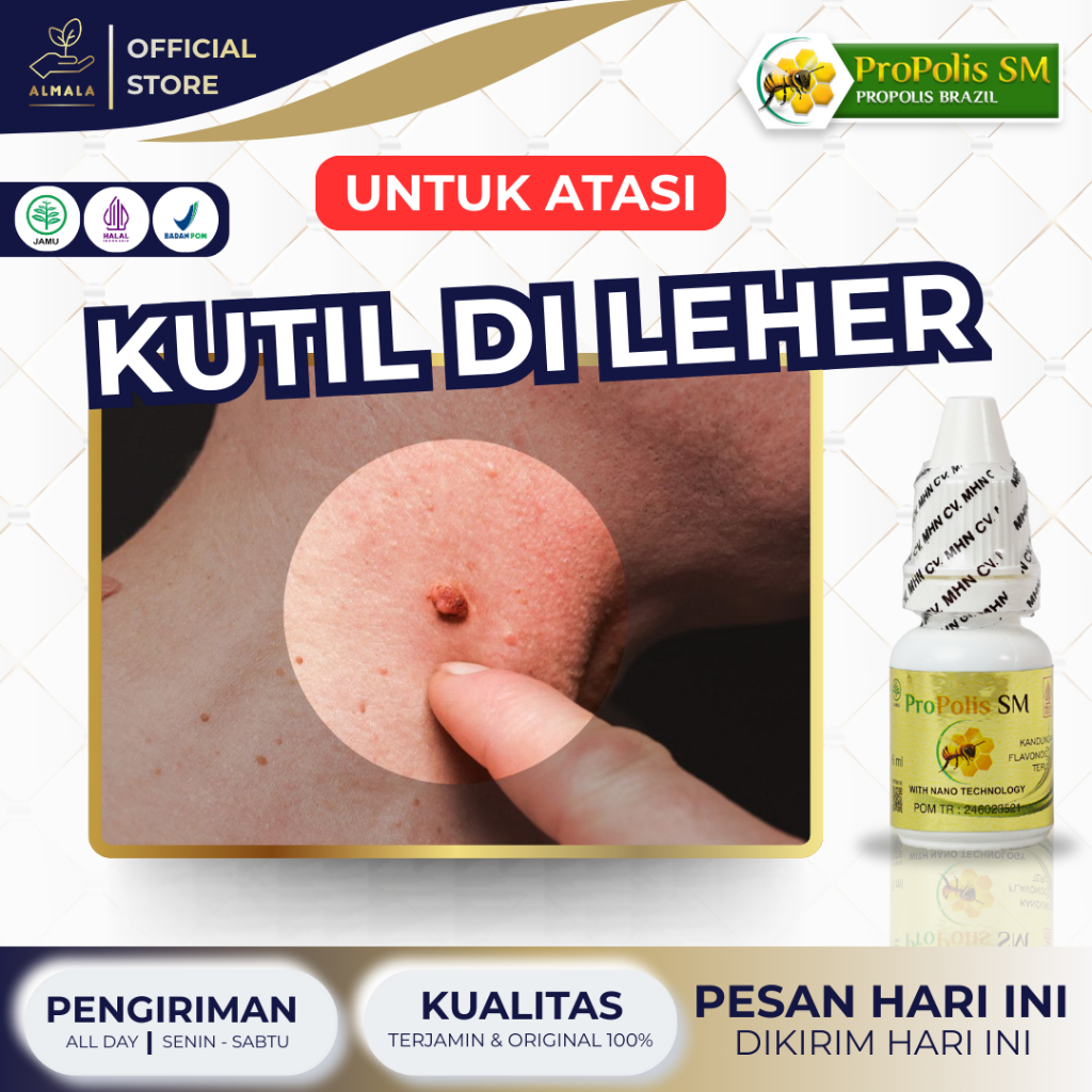 Obat Kutil di Leher, Daging Tumbuh, Daging Jadi, Kutil di Kelopak Mata, Penghilang Kutil Propolis SM