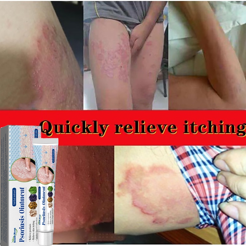 salep gatal china paling ampuh original cream eksim psoriasis obat gatal selangkangan dan hitam krim