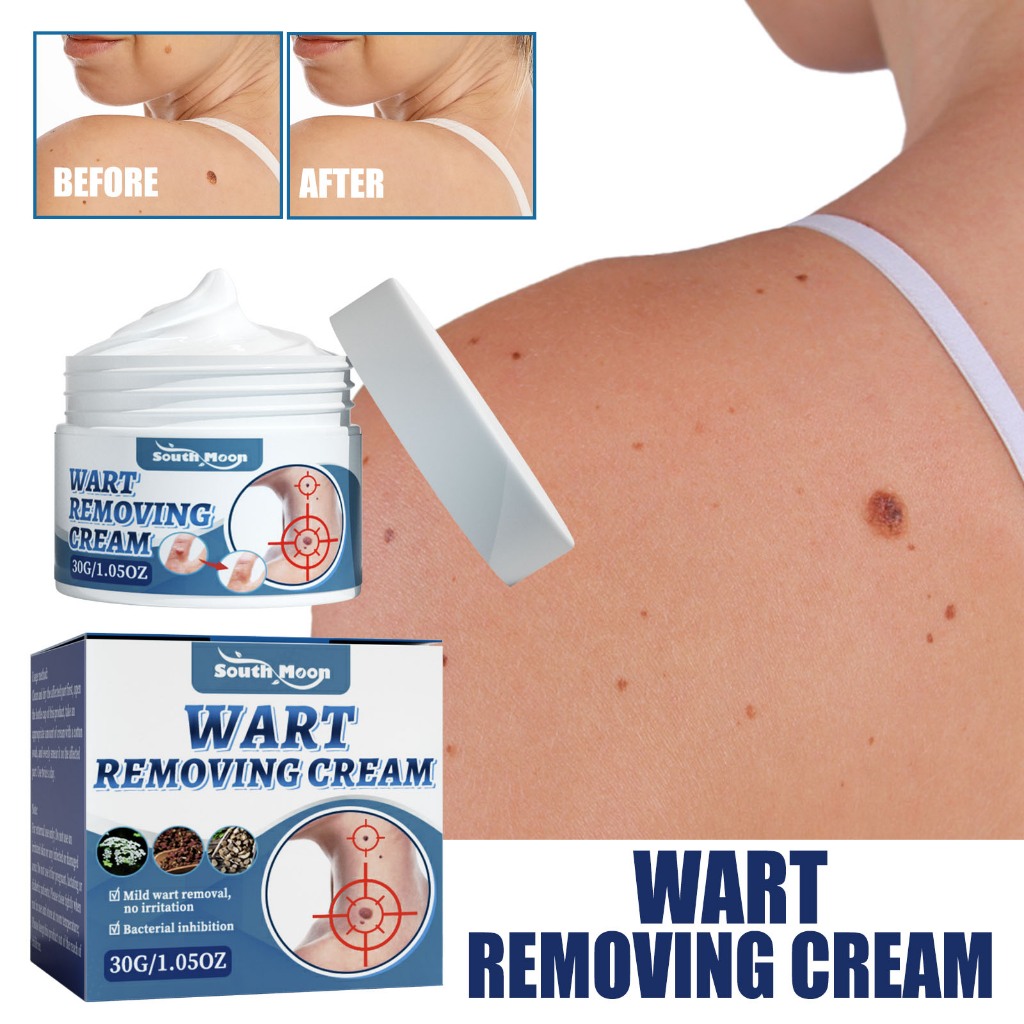 South Moon Wart Removal Cream 30g Krim Penghilang Kutil - Krim Pembersihan Lembut untuk Kutil, Binti