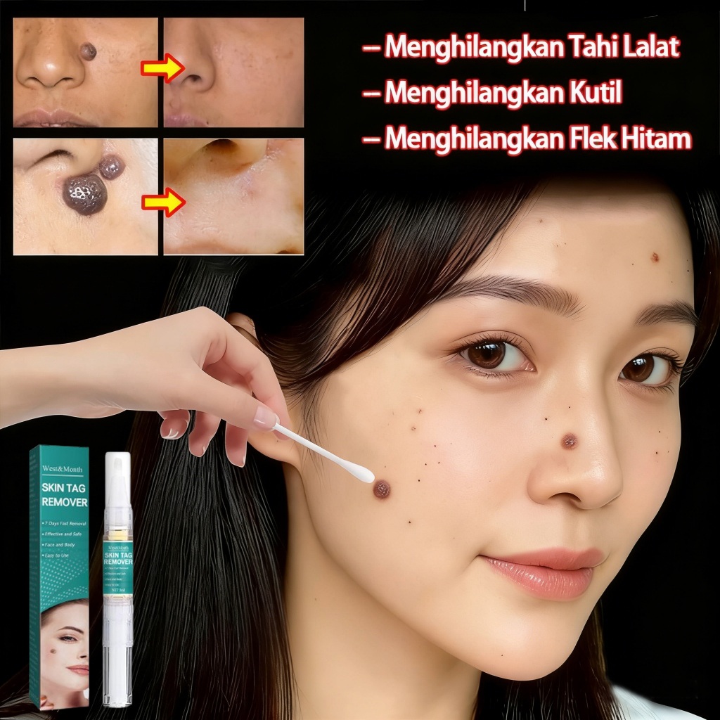 Obat Kutil Ampuh Penghilang Kutil Dan Tahi Lalat Di Wajah Salep Kutil Paling Ampuh Obat Penghilang K