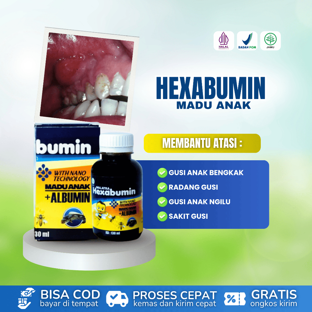Obat Sakit Gusi Anak, Gusi Anak Bengkak, Gusi Anak Ngilu, Radang Gusi Anak Atasi Dengan Hexabumin