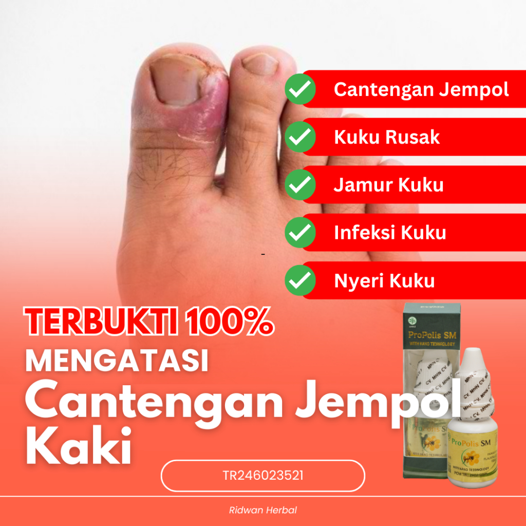 Obat Cantengan Jempol Kaki Obat Kuku Cantengan Obat Kuku Rusak Obat Jamur Kuku Obat Kuku Jamur dan R