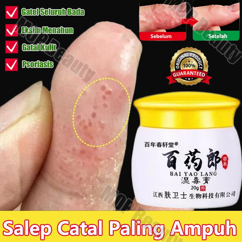 Salep gatal salep eksim kering dan gatal salep china gatal paling ampuh eksim kering salep gatal sel