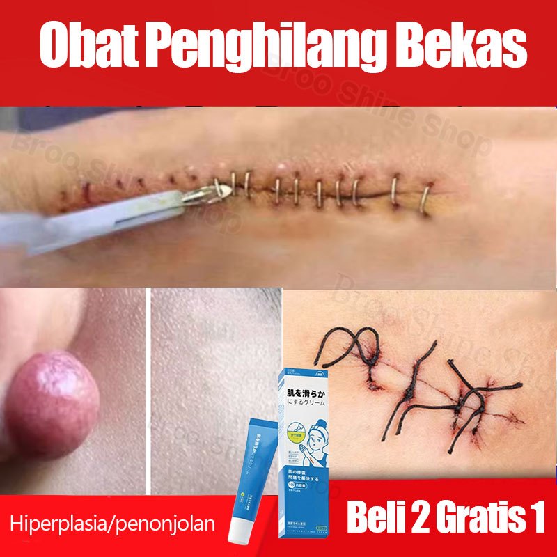 Obat Penghilang Bekas Luka Salep Keloid Paling Ampuh Penghilang Bekas Luka Hitam Menghilangkan Bekas