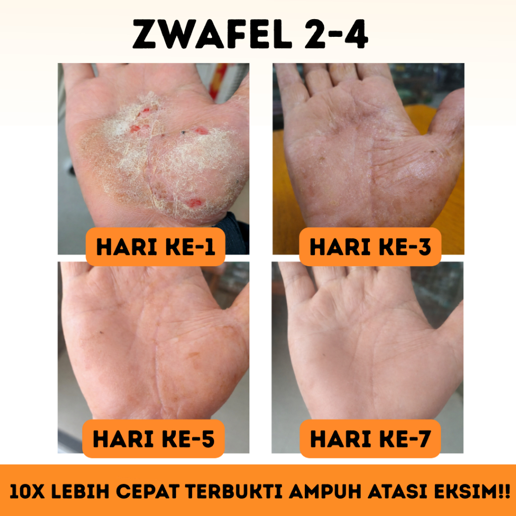 Salep Zwafel 2-4 Original BPOM Obat Kutu Air & Scabies Salep 24 Gatal Selangkangan Eksim Panu Kadas