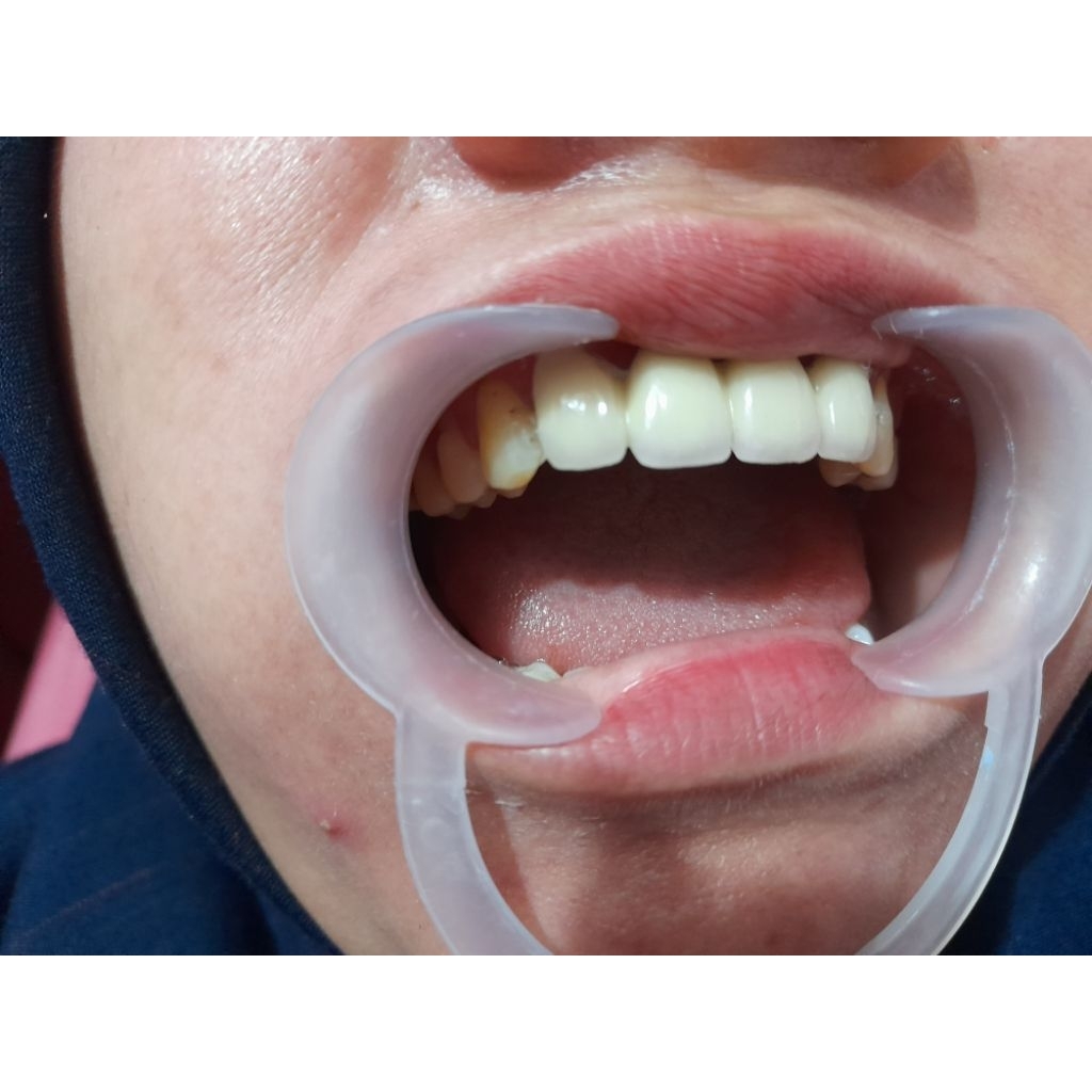 crown gigi/mahkota gigi