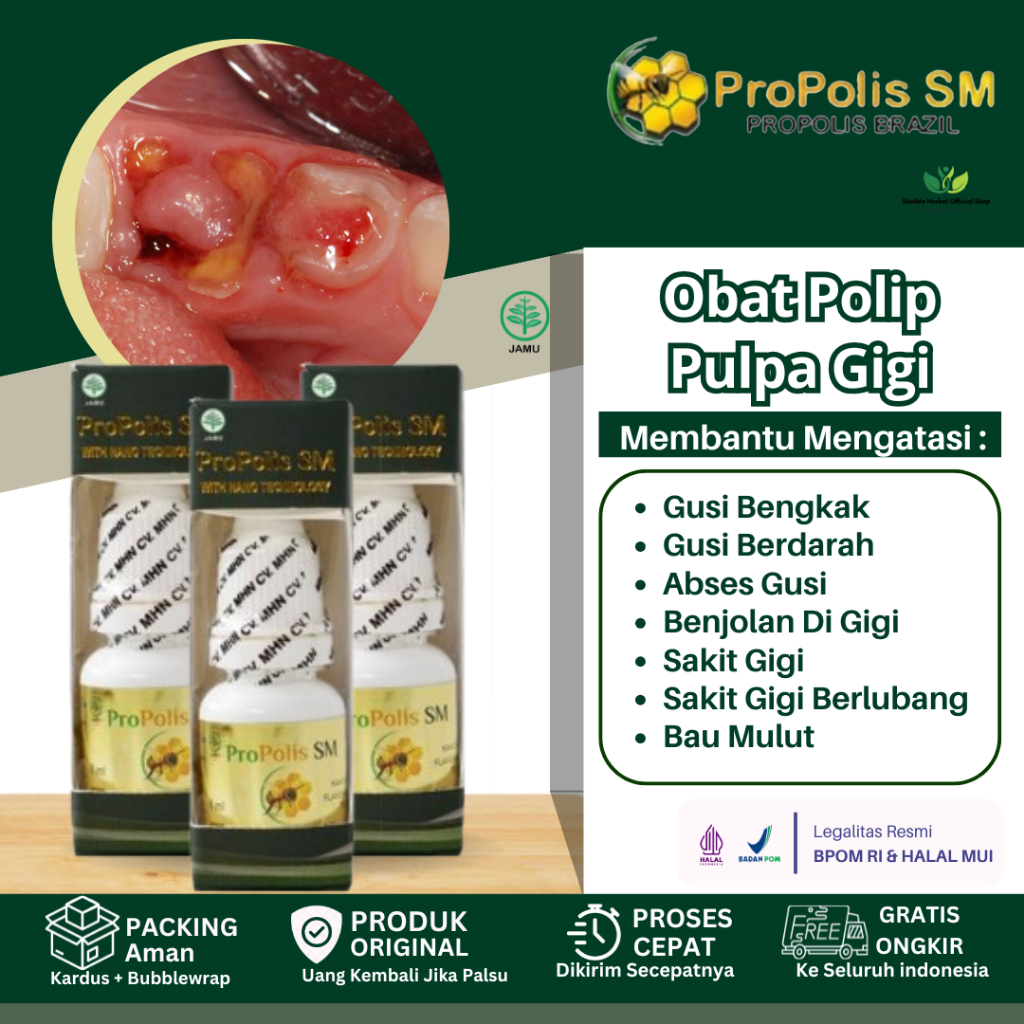Obat  Polip Pulpa Gigi, Daging Tumbuh di Gigi Benjolan Gusi, Sakit Gigi Akibat Polip Pulpa Propolis 