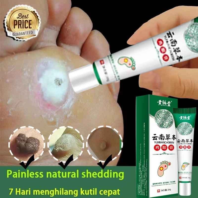 Salep krim Obat Mata Ikan Perontok Penghilang Mata Ikan Pada Telapak Kaki & Tangan