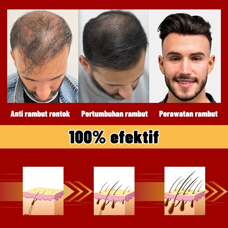 [Segera naik harga]Esensi perangsang pertumbuhan rambut/minyak esensial perangsang pertumbuhan rambu