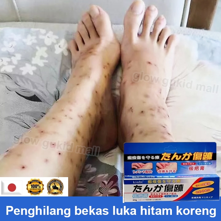penghilang bekas luka hitam koreng menghilangkan bekas luka menghitam bekas gigitan nyamuk keloid pe