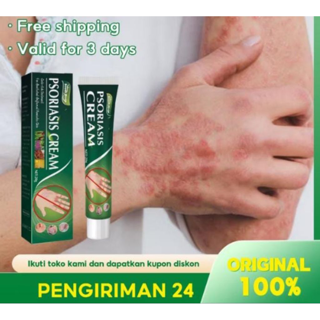 Psoriasis Cream Salep Krim Anti Eksim Obat Gatal Ampuh Merah Inflamasi Ruan Radang Kulit Seluruh Tub