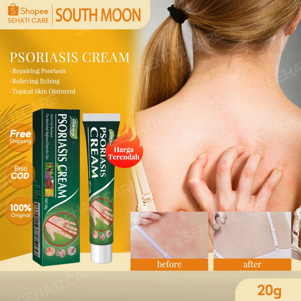 South Moon Psoriasis Cream 20g Obat Kulit Psoriasis For Itchy Psoriasis Skin Penghilang Gatal Cepat 