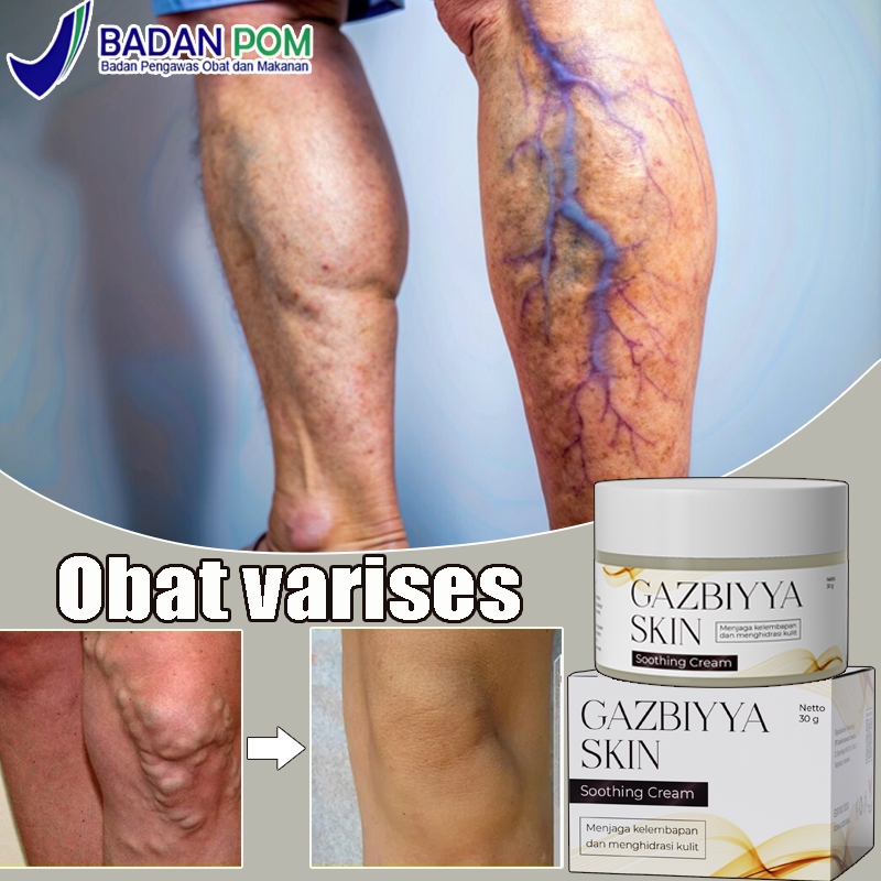 Obat varises Varicose veins cream Cream varises paling ampuh original Salep varises 30g obat varises