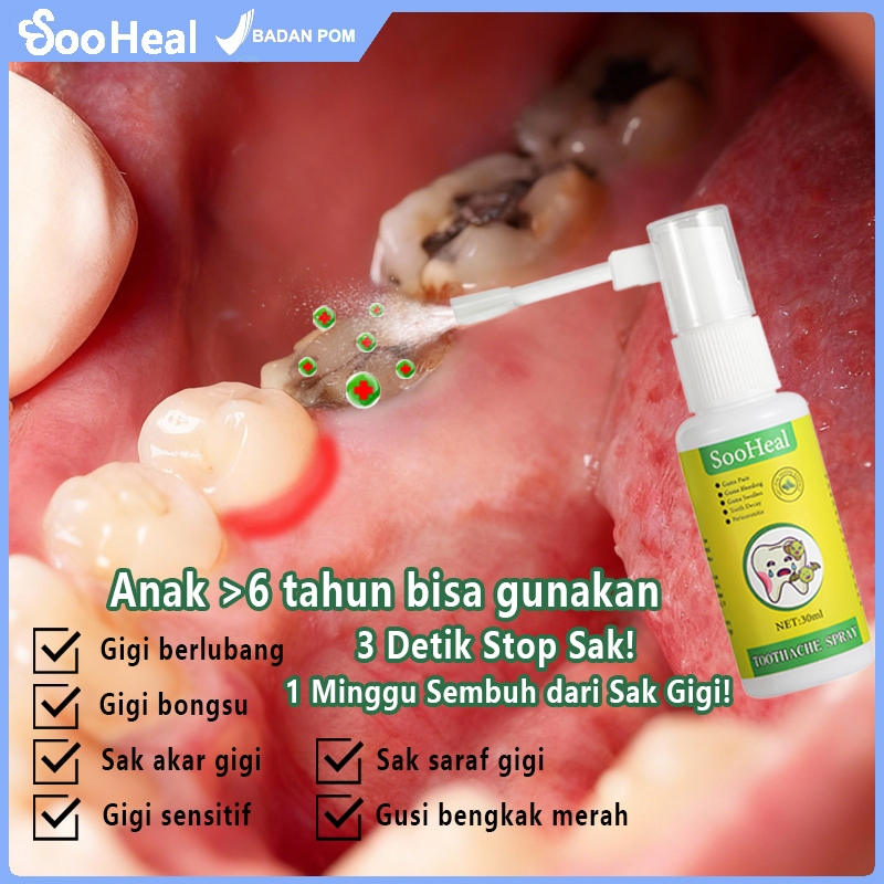 Paket Spray Sakit Gigi  - Spray Sakit Gigi (Sakit Gigi Ampuh, Obat Sakit Gigi, Obat Sakit Gigi Berlu