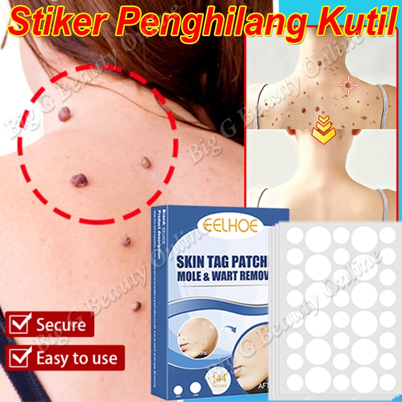 Stiker Penghilang Kutil Ampuh Penghilang Kutil Dan Tahi Lalat Wart Removal Original Patch Plester Ma