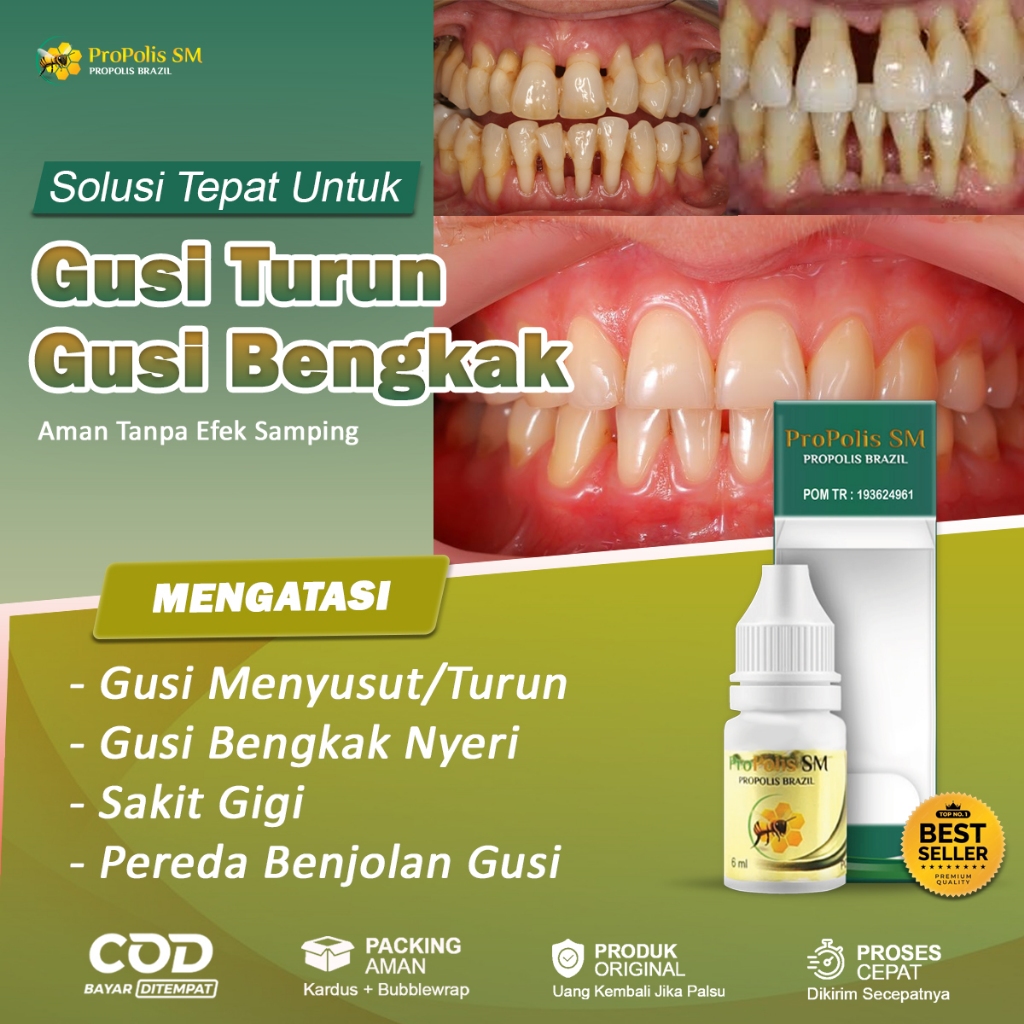 Obat Gusi Bengkak Gusi Turun Sakit Gigi Berlubang Radang Gusi Gusi Berdarah Gingivitis Abses Gusi Be