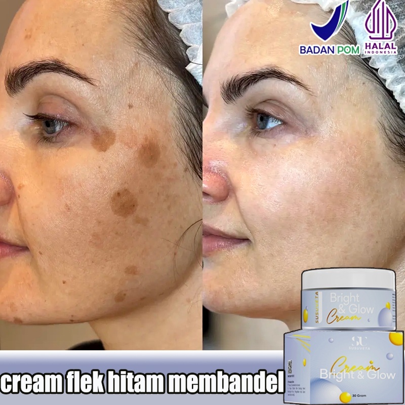 Salep flek hitam membandel Cream flek hitam membandel Menghilangkan flek hitam di wajah krim penghil