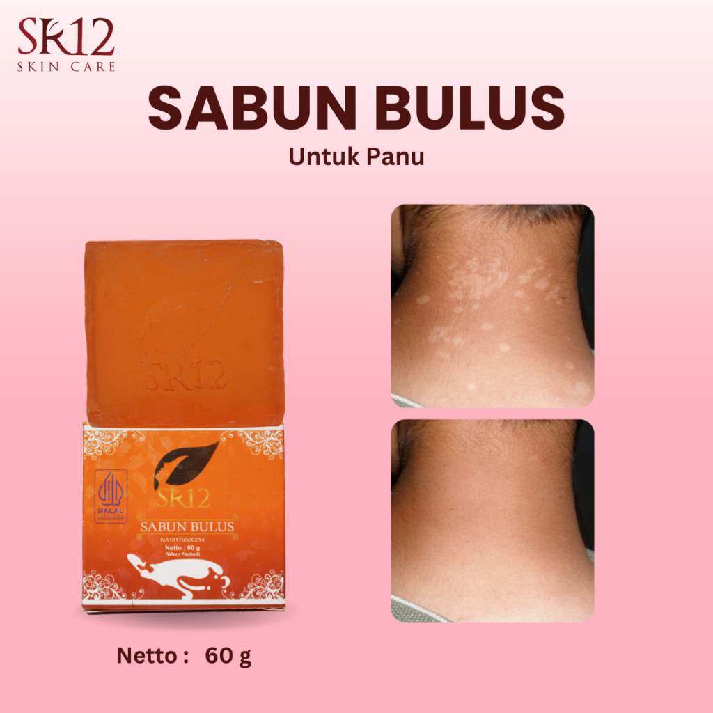 SABUN PANU PALING AMPUH 100% - SABUN PENGHILANG PANU - SABUN PANU AMPUH - SABUN ANTI PANU - SABUN OB