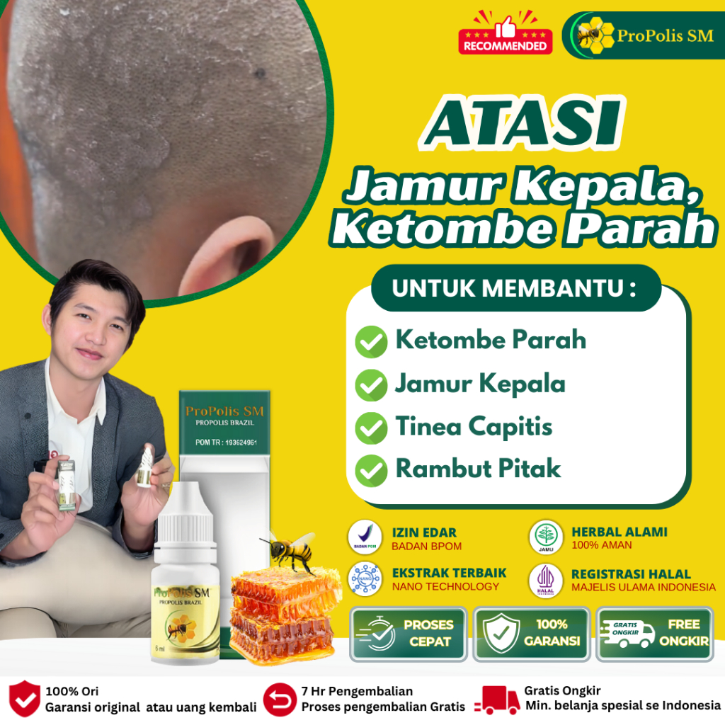 obat gatal kepala ketombe Obat Psoriasis Parah Gatal Kulit Kepala Jamur Kulit Kepala Borok di Kepala