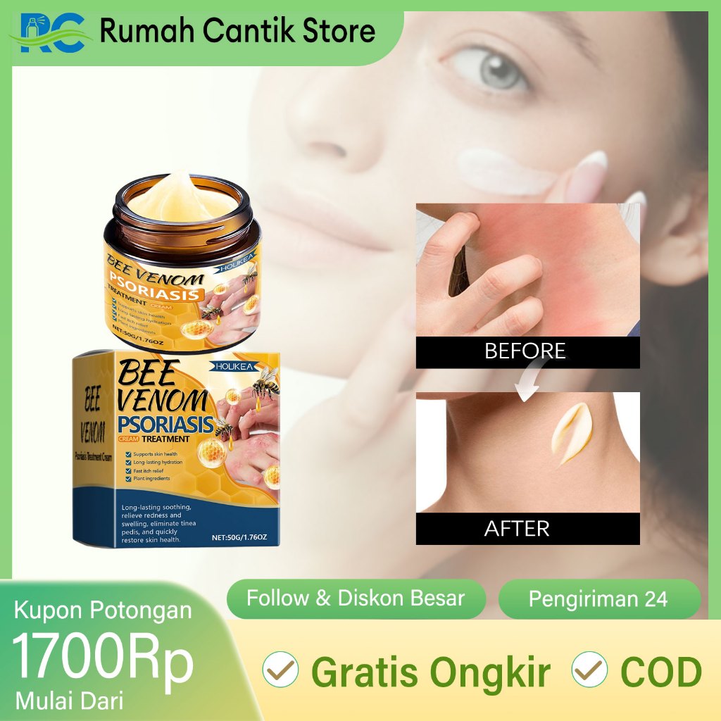 Houkea Krim Psoriasis Salep Khusus Gatal Paling Ampuh Obat Meredakan Efektif Cepat Redakan Kemerahan