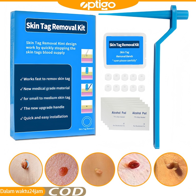 Obat Kutil Alat Pencabut Skin Tag Kit Penghilang Tag Kulit Alat Pencabut Skin Tag High Quality