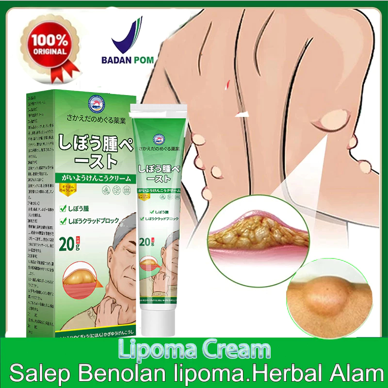 Lipoma Removal Cream Original Obat Benjolan 20g Salep krim Benjolan lipoma Benjolan obat Uci Uci Lip