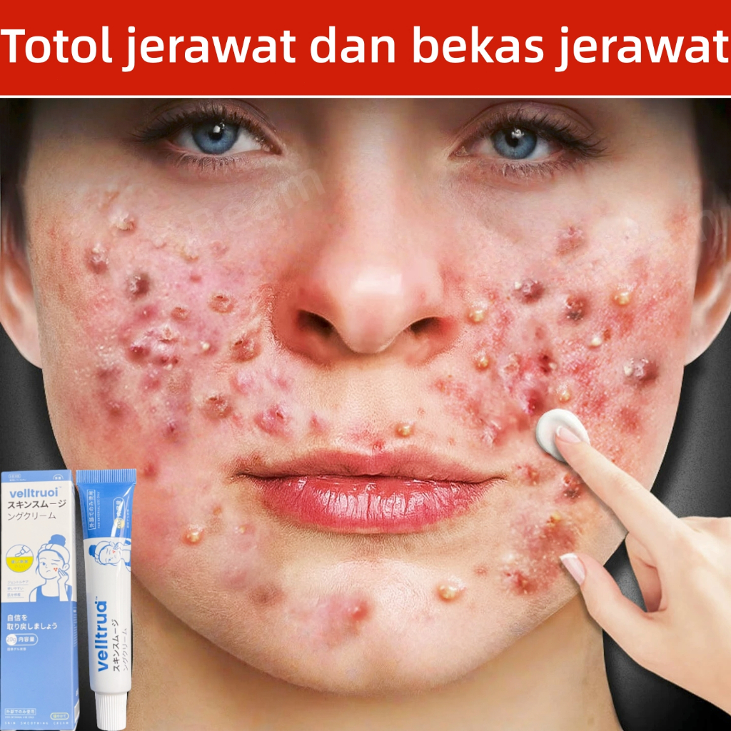 Salep jerawat penghilang jerawat bekas jerawat dan bekas jerawat hitam membandel Mengurangi Peradang