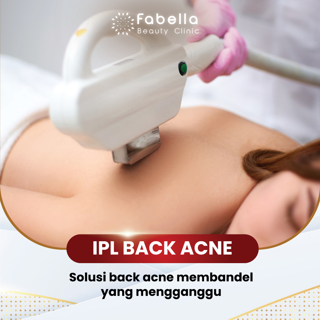 IPL BACK ACNE Treatment