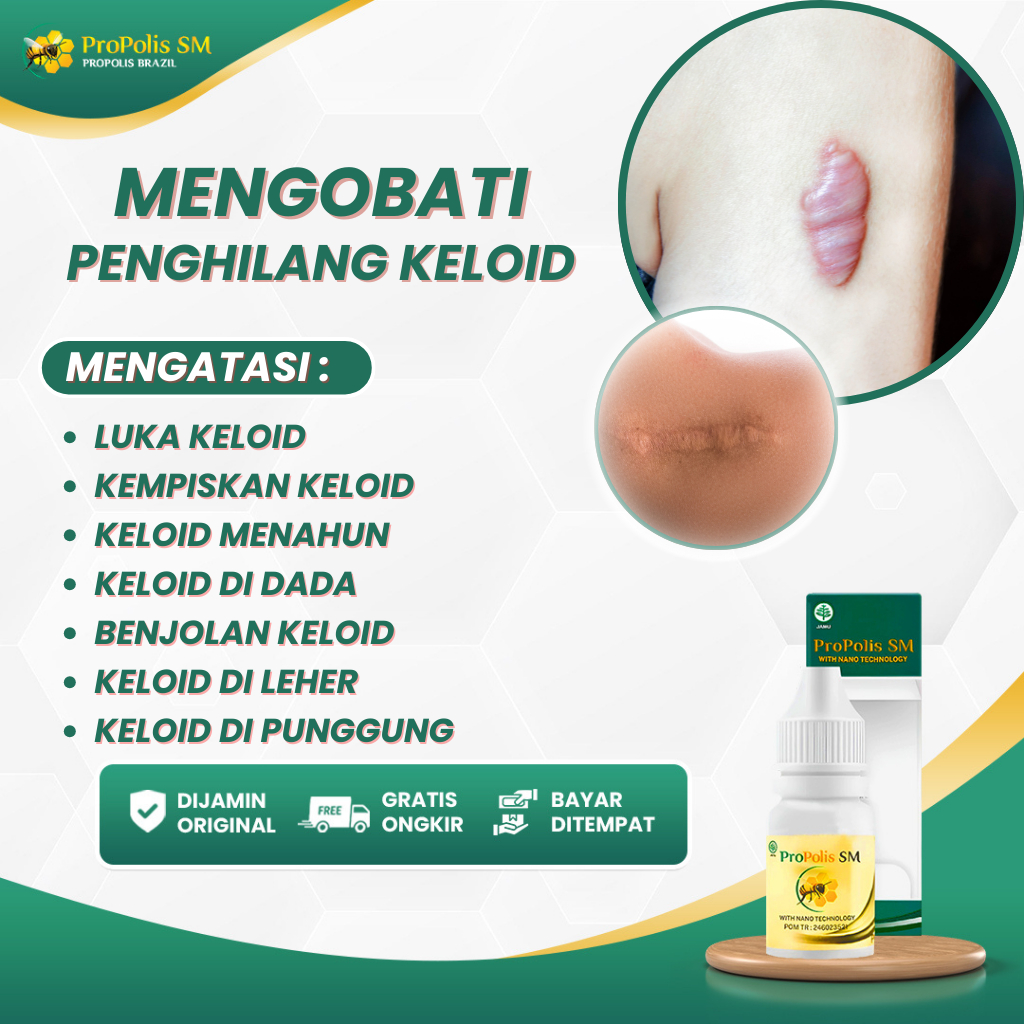 Propolis SM Asli 100% Original Obat Herbal Atasi  Keloid Di Dada. Keloid Menahun, Penghilang Keloid,
