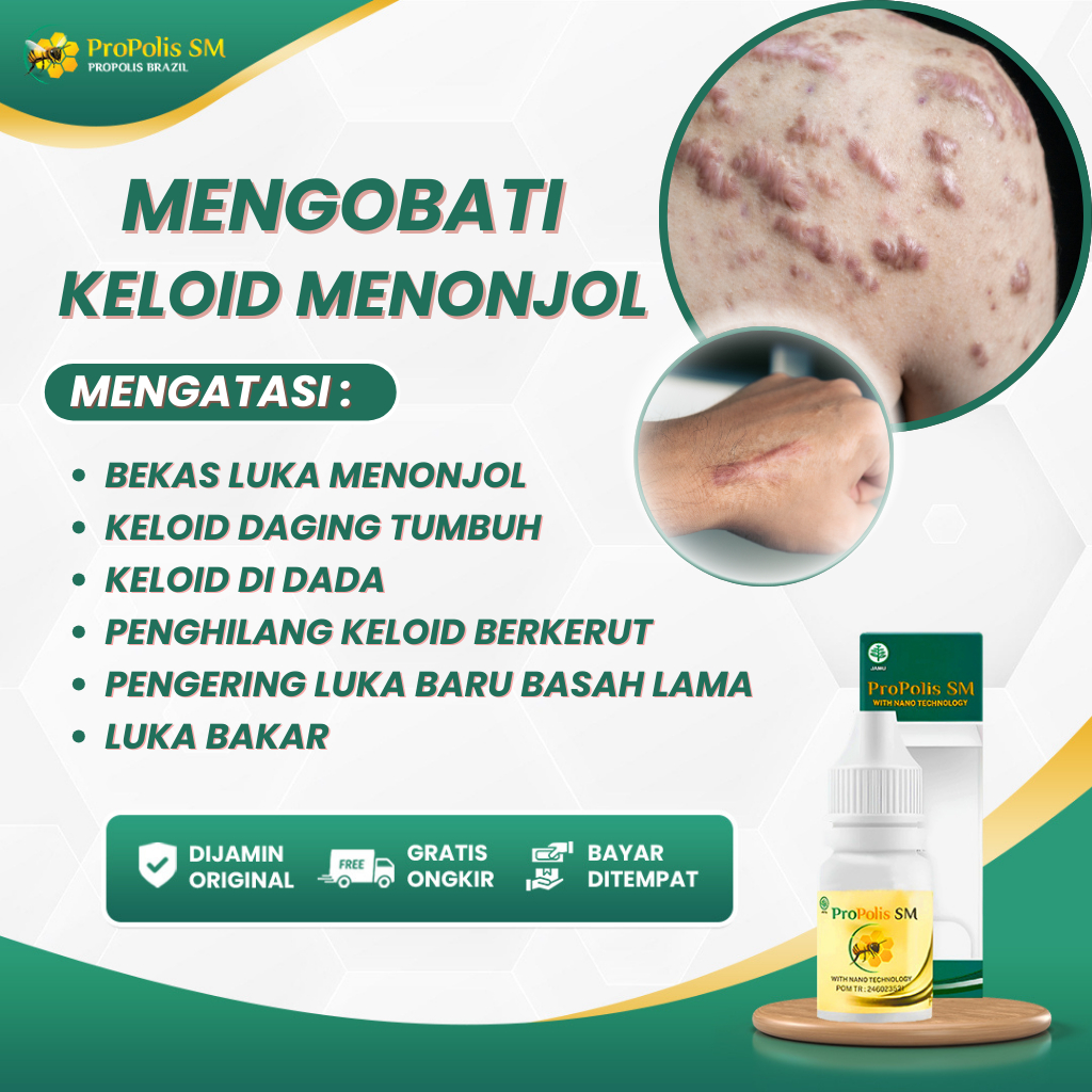 Obat Keloid Menonjol Bekas Luka Menonjol, Keloid Daging Tumbuh, Keloid Di Dada, Penghilang Keloid Be