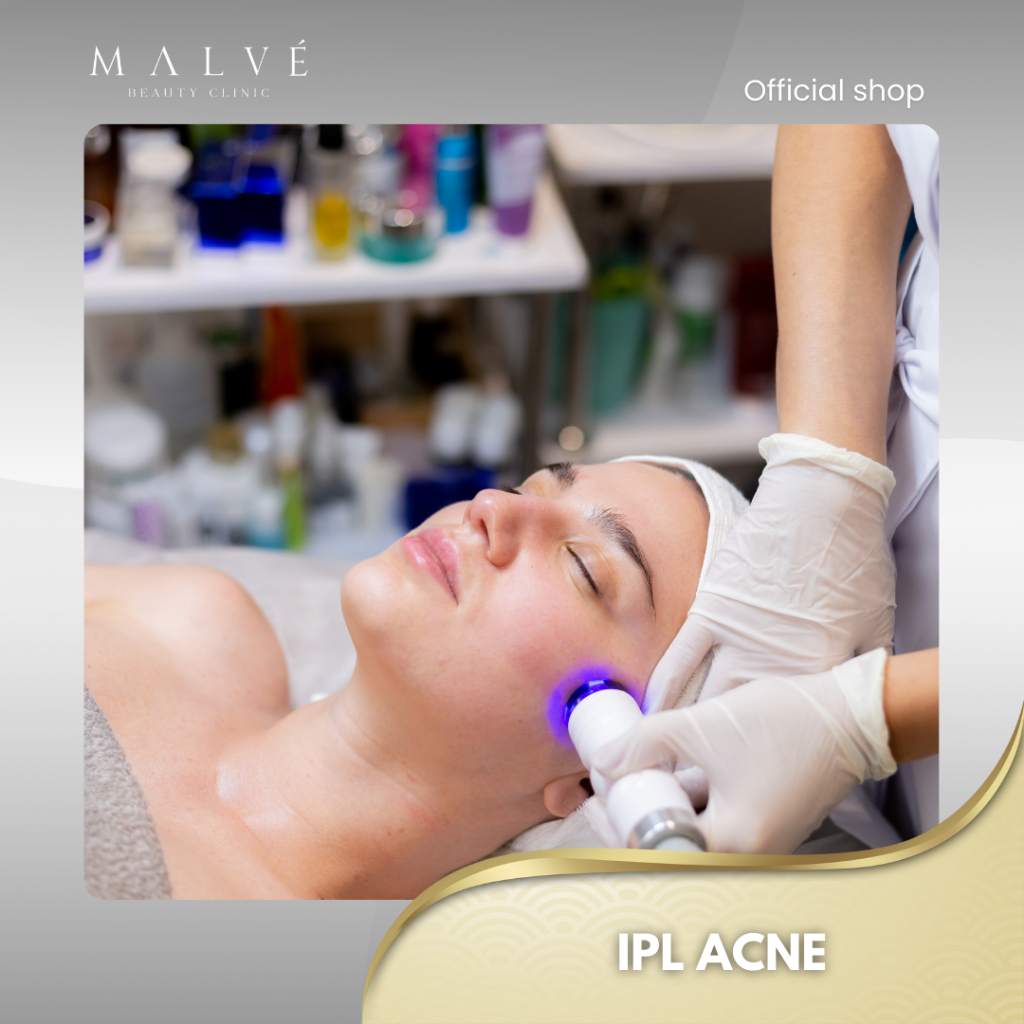 MALVE IPL Acne Treatment