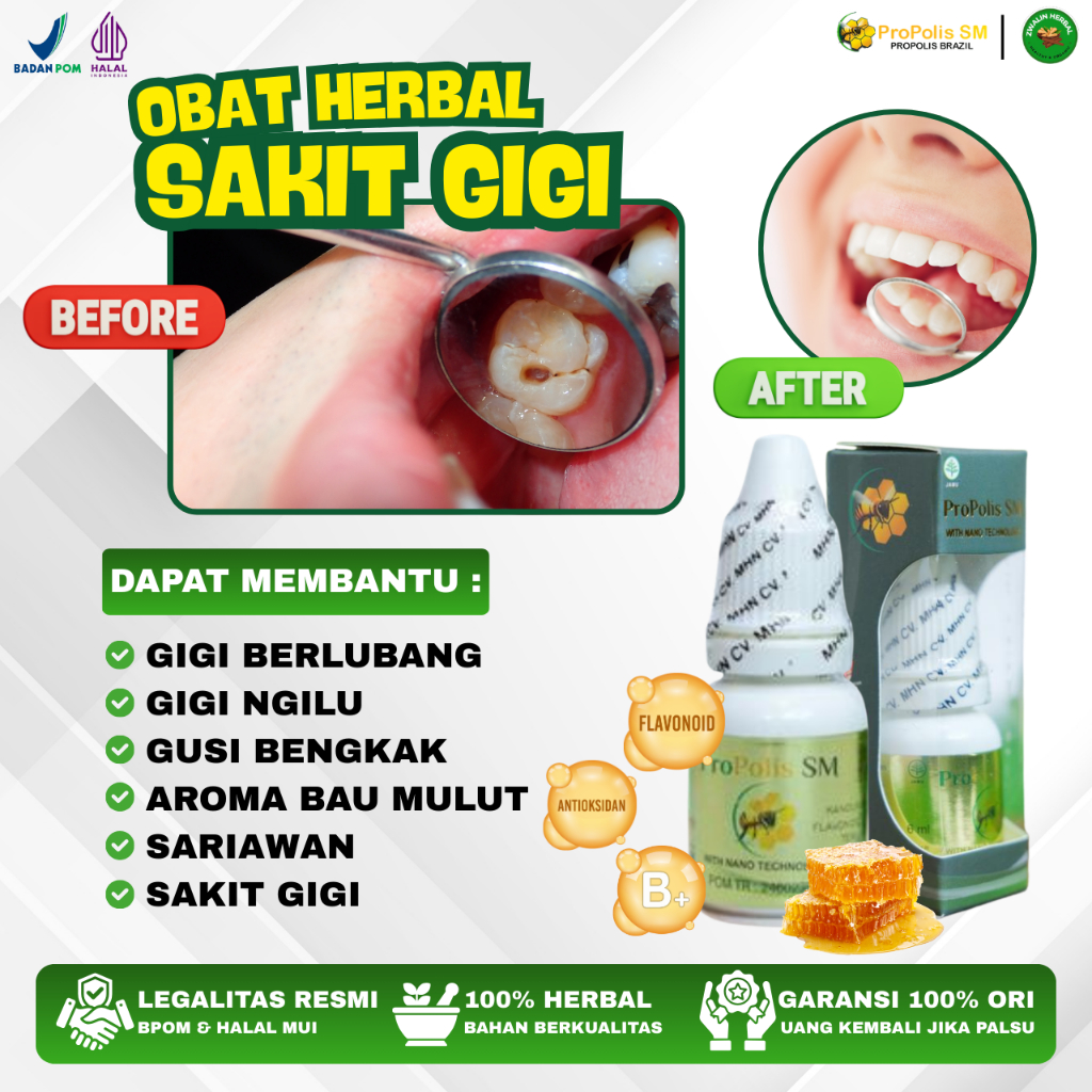 Obat Perontok Akar Gigi Berlubang, Obat Gigi Berlubang Agar Cepat Copot, Obat Penghilang Sisa Gigi B