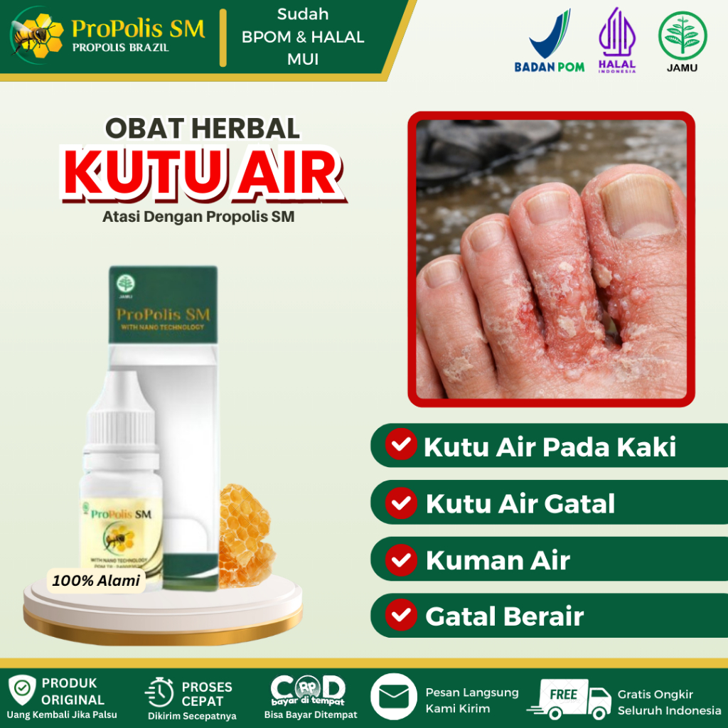 Propolis SM Obat Kutu Air Pada Kaki, Sela Jari Kaki, Kutu Air Telapak Kaki, Kutu Air Gatal Parah, Pe