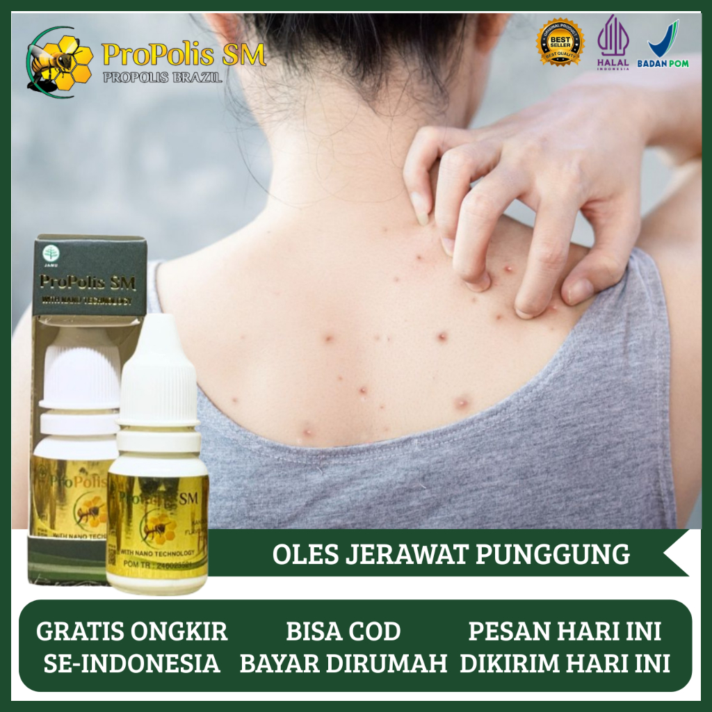 Obat Oles Jerawat Punggung Wajah Dahi Pipi Dagu, Obat Bekas Jerawat, Obat Bintik Merah di Punggung, 