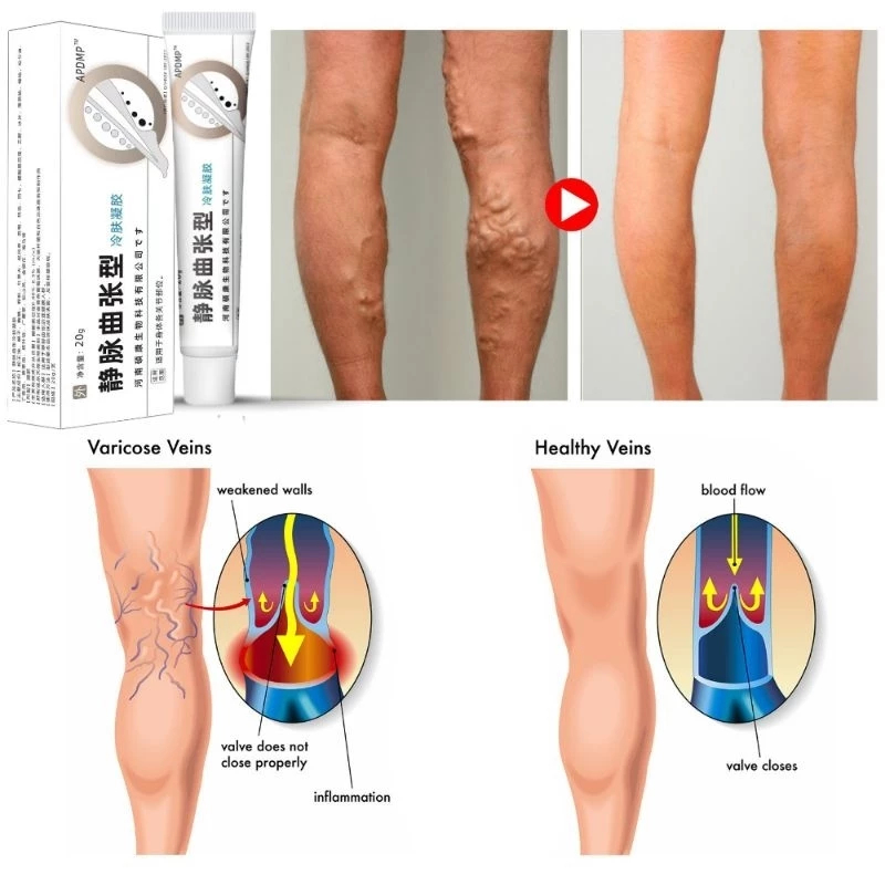 SALEP OBAT VARISES APDMP  ORIGINAL 100% OBAT VARISES / Obat Varises