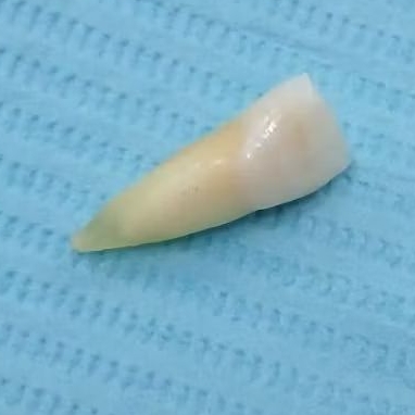 Gigi Asli Insisivus 21 / Gigi Asli Manusia