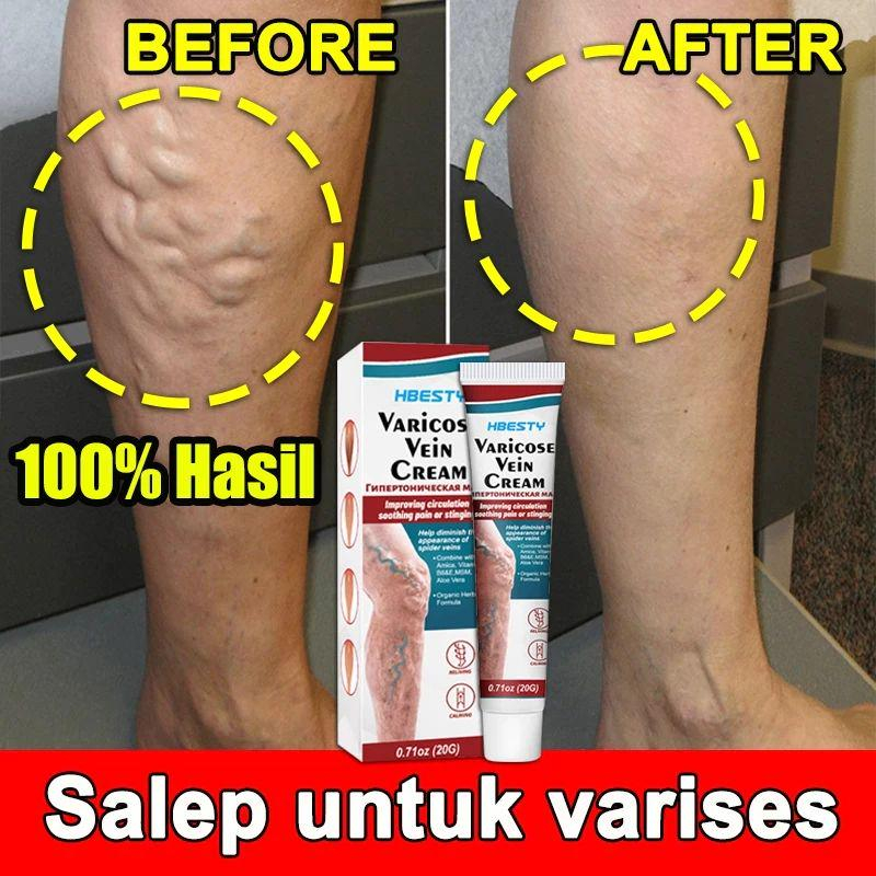 Krim Varises Krim Sirkulasi Darah 20g Krim Varises Lansia&Perawatan Kaki Hamil  Krim penghilang vari